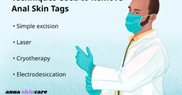 anal skin tag causes, removal, treatment & prevention