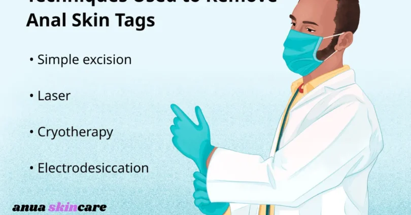 anal skin tag causes, removal, treatment & prevention