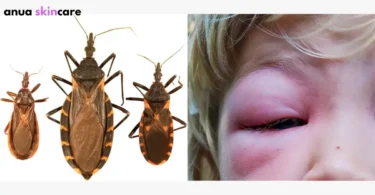 bug skin explained insect armor & human bite care