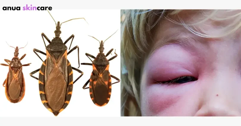 bug skin explained insect armor & human bite care