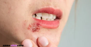 pimple or herpes key differences, symptoms & treatment