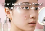 clear liquid from a pimple what it really means